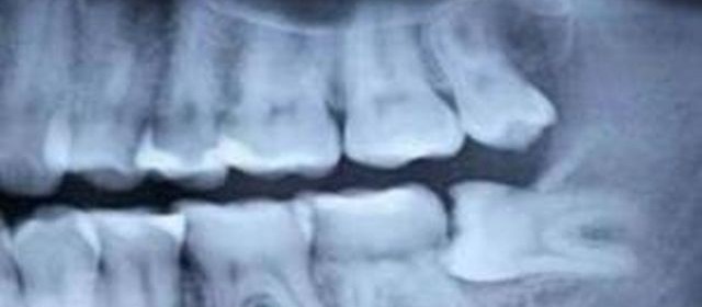 dentalno zdrave i mudrezi